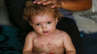 الامراض الجلدية في مخيمات النزوح بغزة