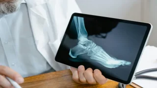 من الملابس إلى غرف العمليات.. هل يزيح “كيراتين الصوف” الكولاجين عن عرش ترميم العظام؟