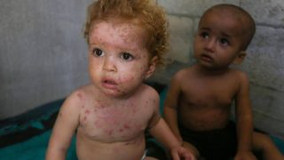 الأمم المتحدة: مخاوف من انتشار واسع لجدري الماء في قطاع غزة